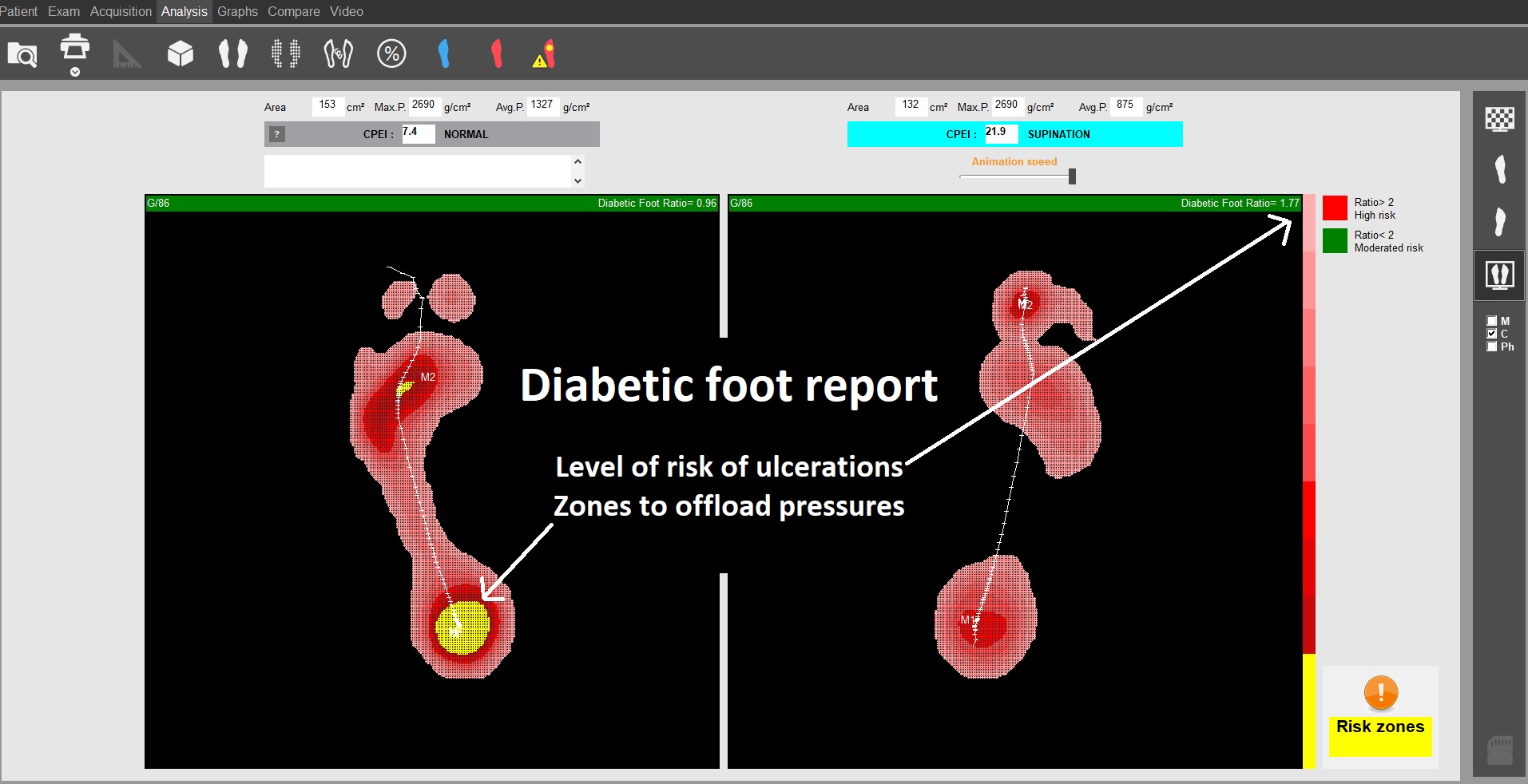 T plate diabetic foot report